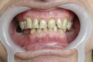 Teeth before the treatment