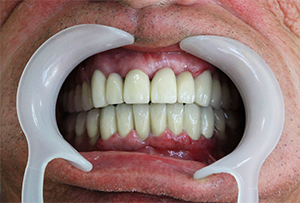 Teeth after the treatment