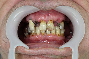 Zahnsituation vor der Behandlung