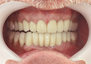 Зубы после лечения